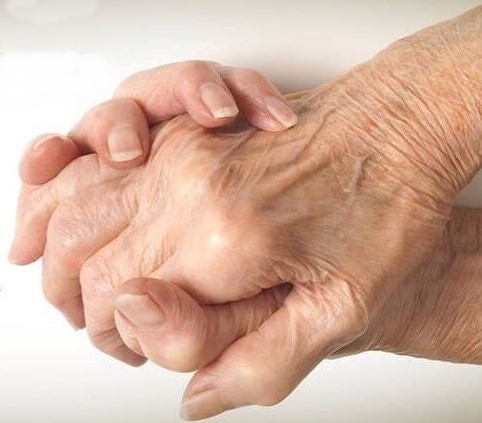 Artrit Hastalığı Hakkında Bilgilendirme Yapıldı